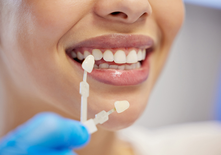 EMAX Veneers